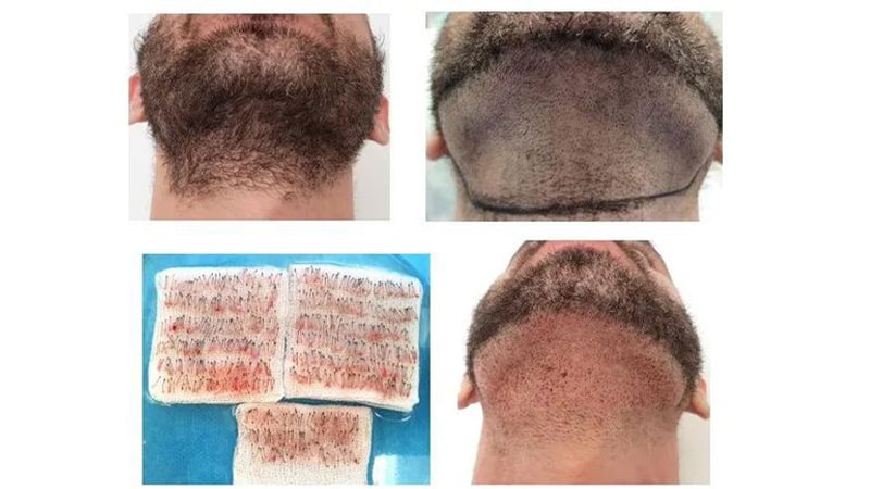 روش های جایگزین در صورت فقدان بانک موی مناسب روش های جایگزین در صورت فقدان بانک موی مناسب